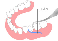 圧排糸による歯肉圧排で精密な型取り