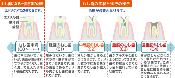 むし歯の進行