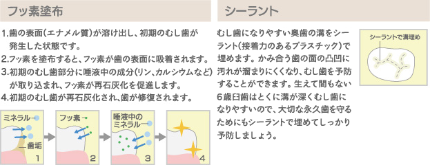 フッ素塗布/シーラント